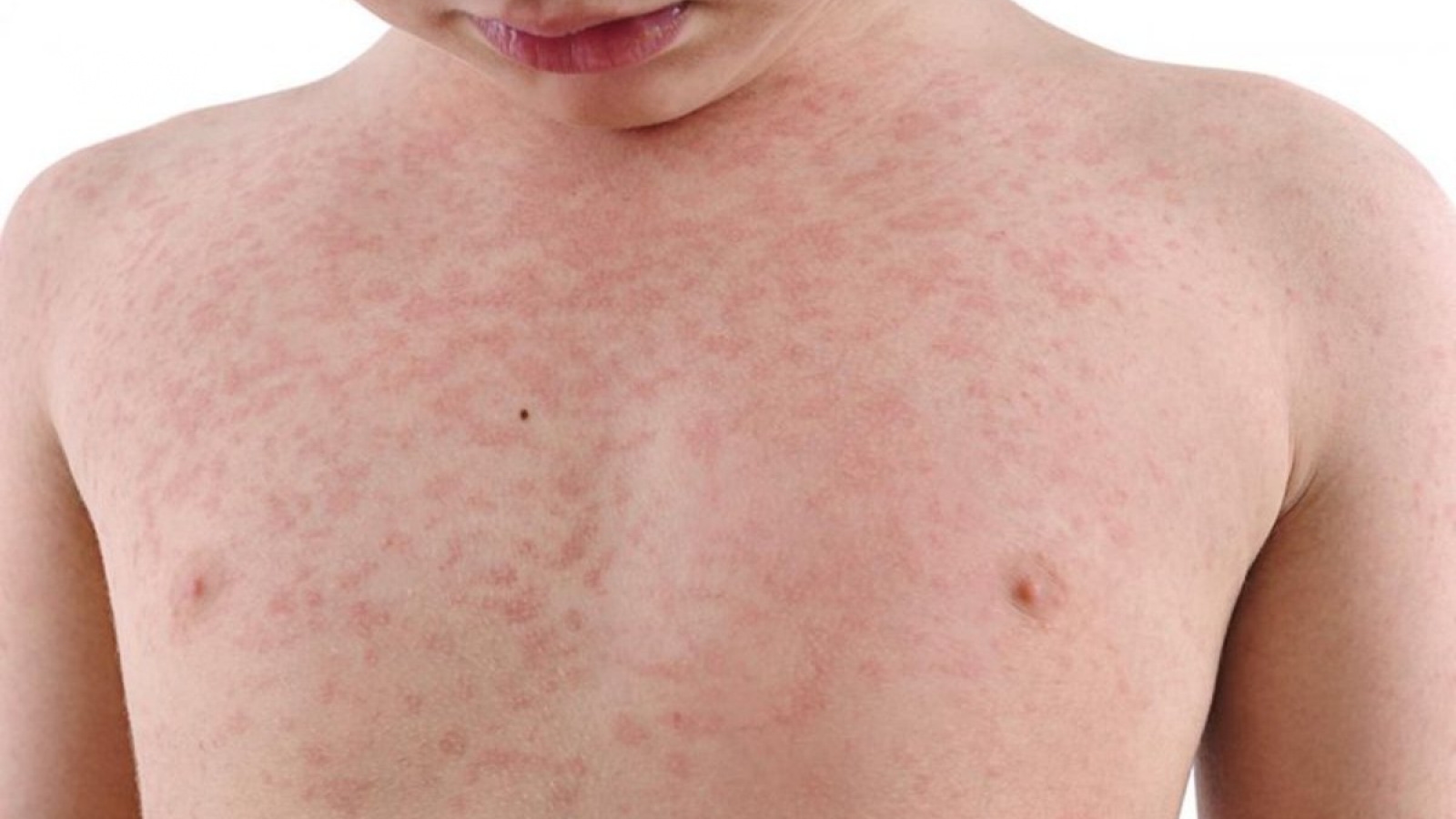 9 bệnh da liễu nguy hiểm ở trẻ