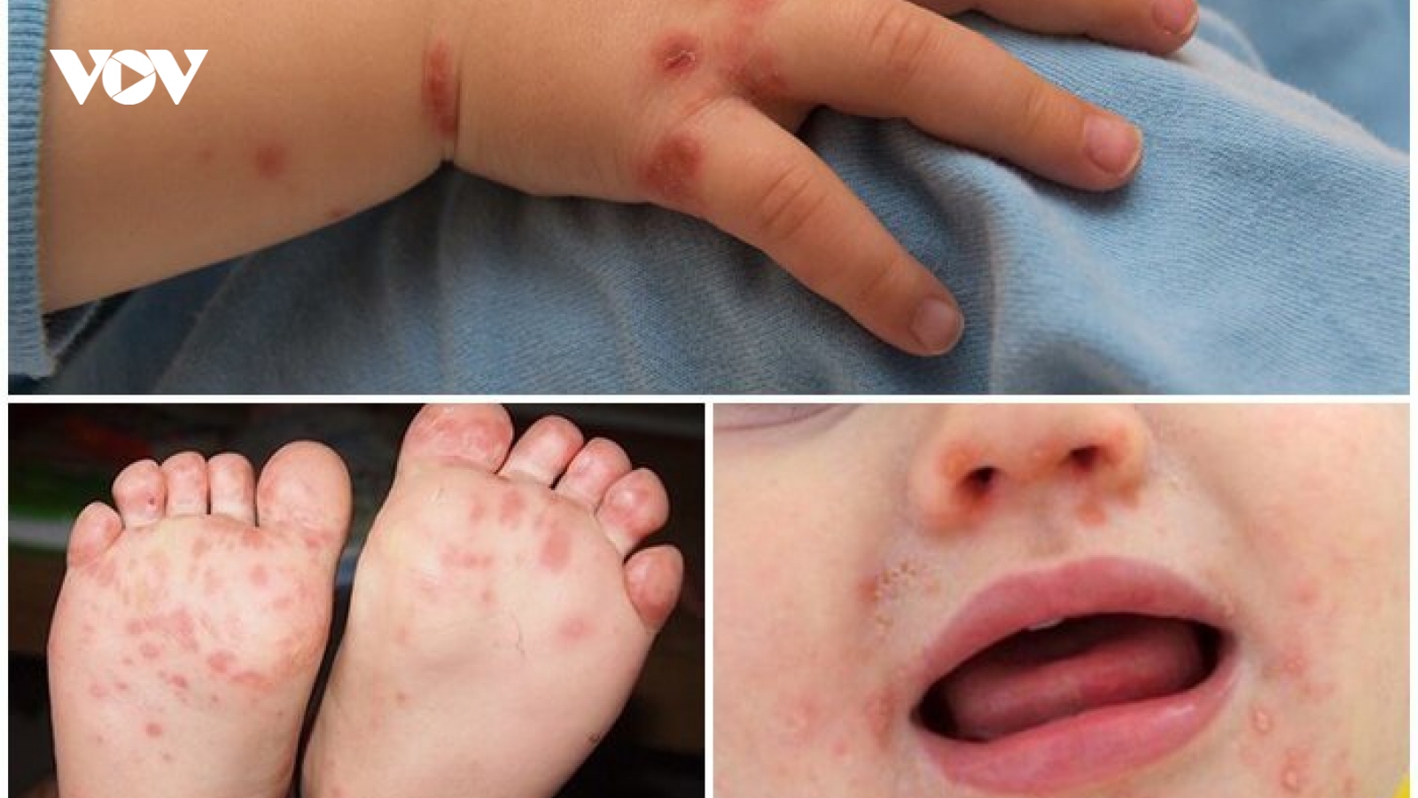 Không nên hoang mang việc thiếu thuốc điều trị bệnh tay chân miệng ở trẻ em