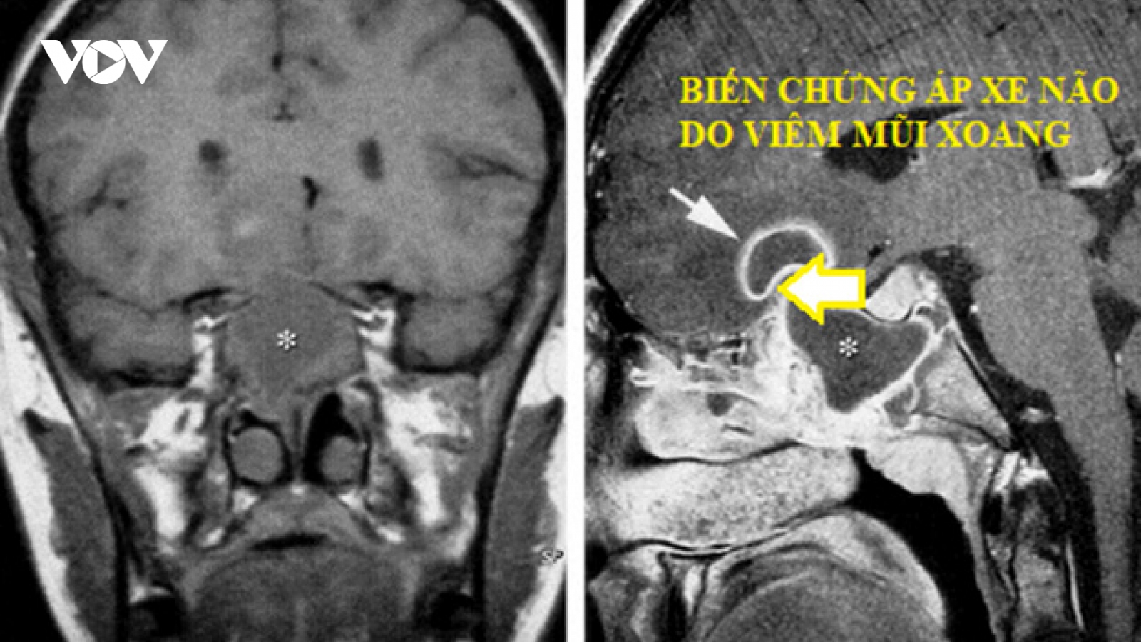 Viêm mũi xoang có thể biến chứng như thế nào?