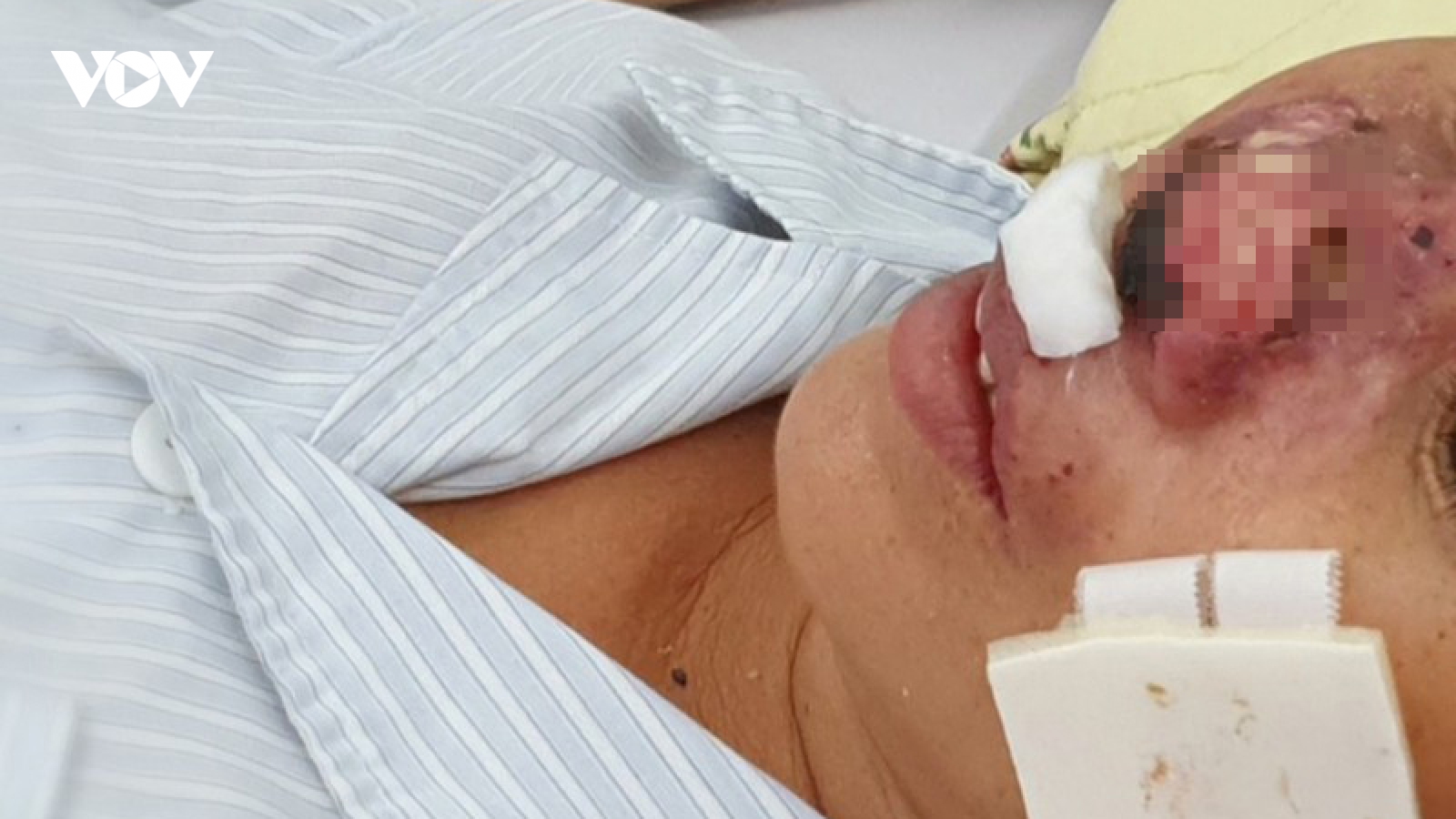 Bác sĩ khuyến cáo cách phòng bệnh Whitmore tại vùng mưa lũ