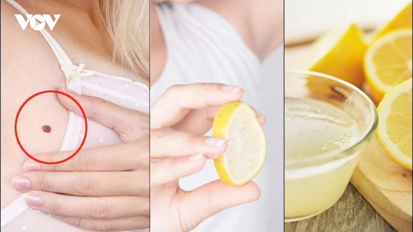 8 biện pháp tự chế để loại bỏ mụn thịt trên da