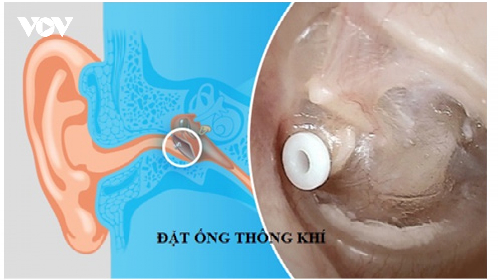 Những rủi ro có thể xảy ra khi nạo VA và đặt ống thông khí