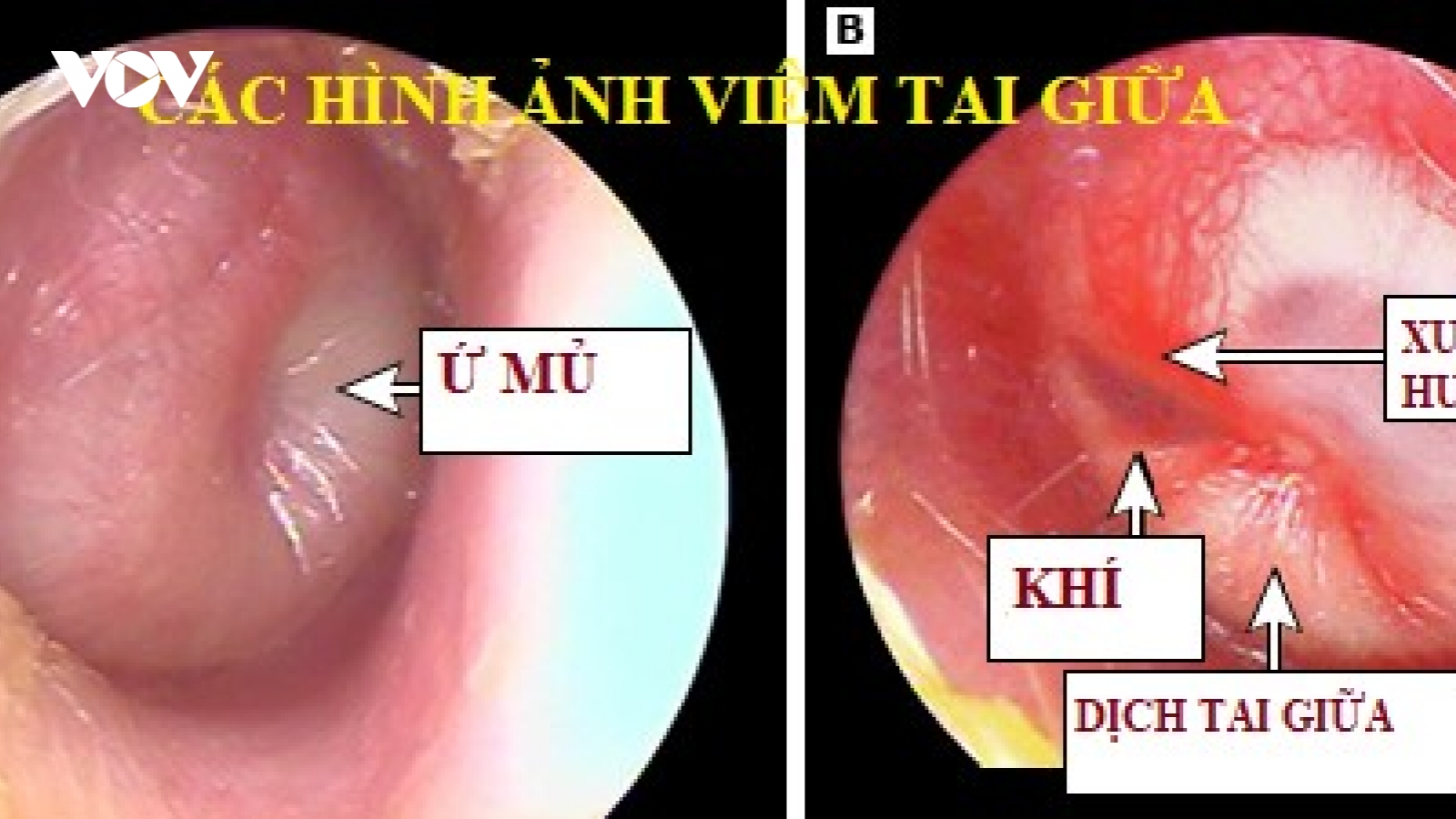 Trẻ bị viêm tai giữa- chăm sóc như thế nào?