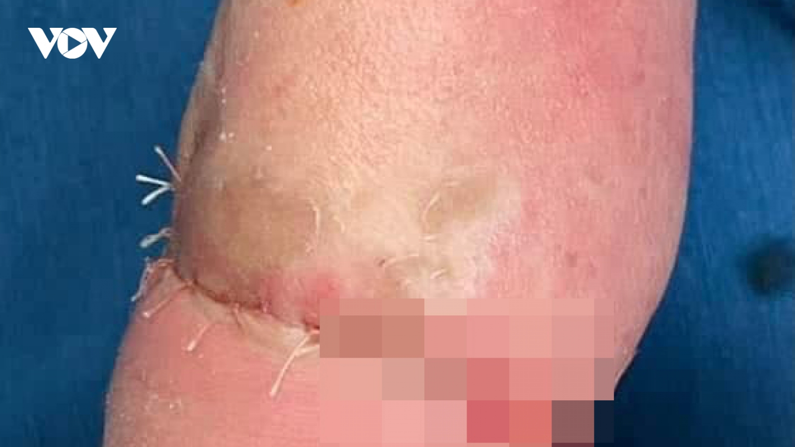 Phẫu thuật thành công cho bé trai mắc hội chứng vòng thắt bẩm sinh