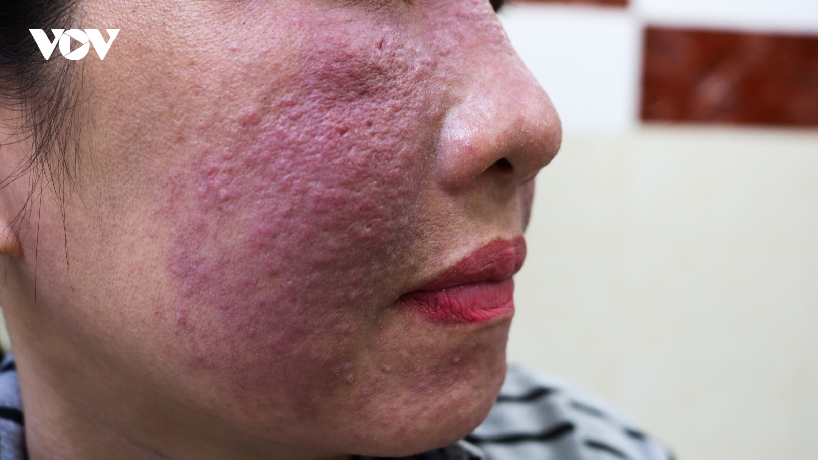 Tham làm trắng da cấp tốc đón Tết, nhiều chị em bị tai biến da mặt