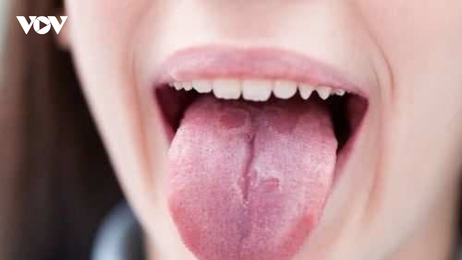 Xuất hiện 3 triệu chứng mới là dấu hiệu ban đầu mắc COVID-19