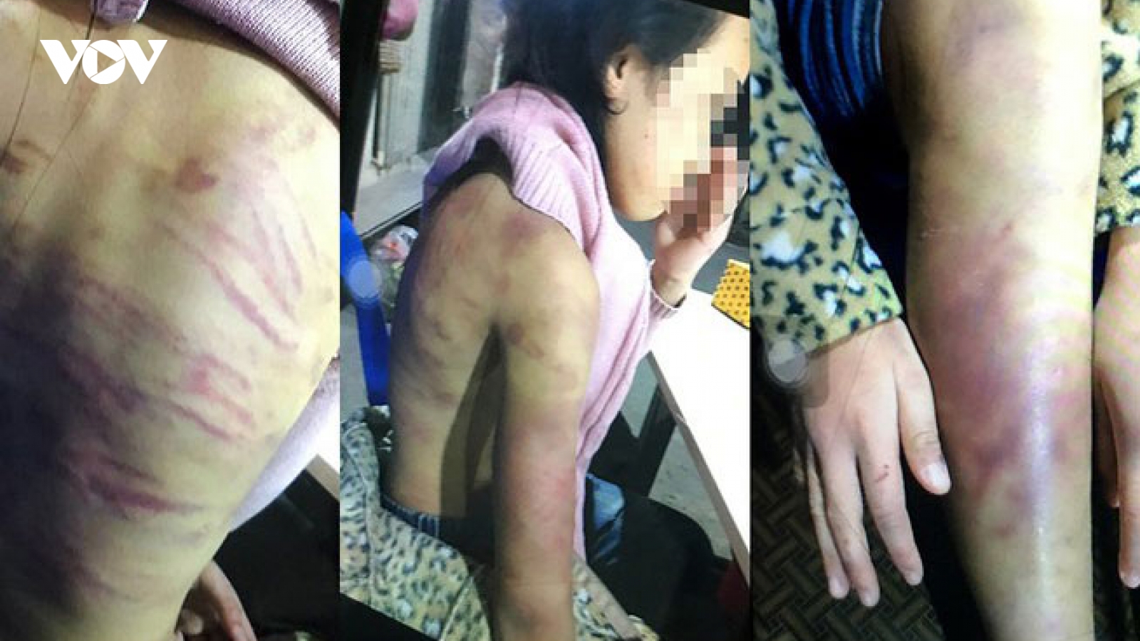 Bé gái 12 tuổi nghi bị bạo hành, xâm hại tình dục: Hà Nội chỉ đạo khẩn
