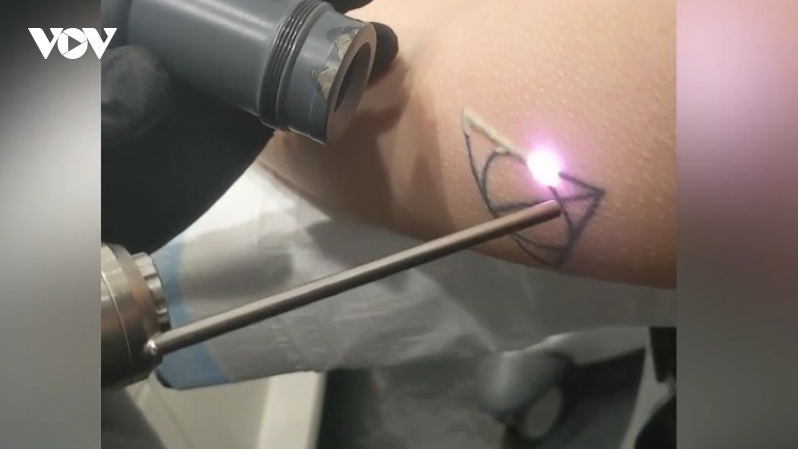 Cận cảnh tia laser loại bỏ hình xăm Harry Potter trên cơ thể người