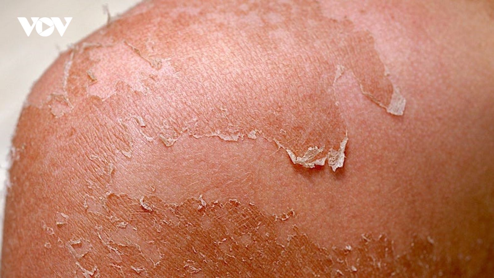Mách bạn cách điều trị bong tróc da do cháy nắng