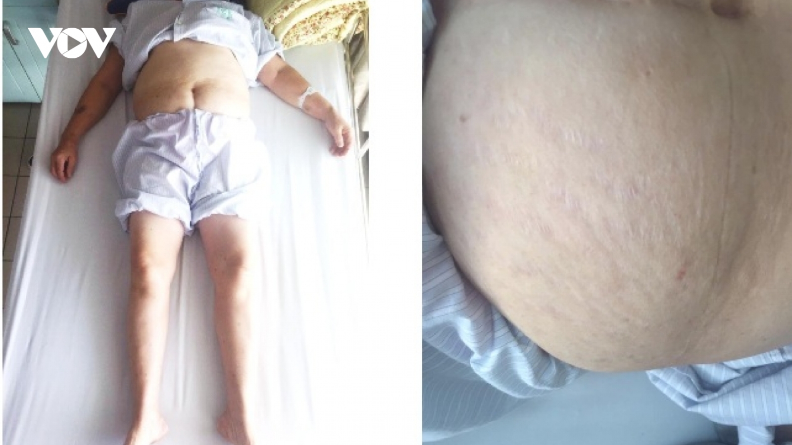 Suy tuyến thượng thận vì lạm dụng corticoid