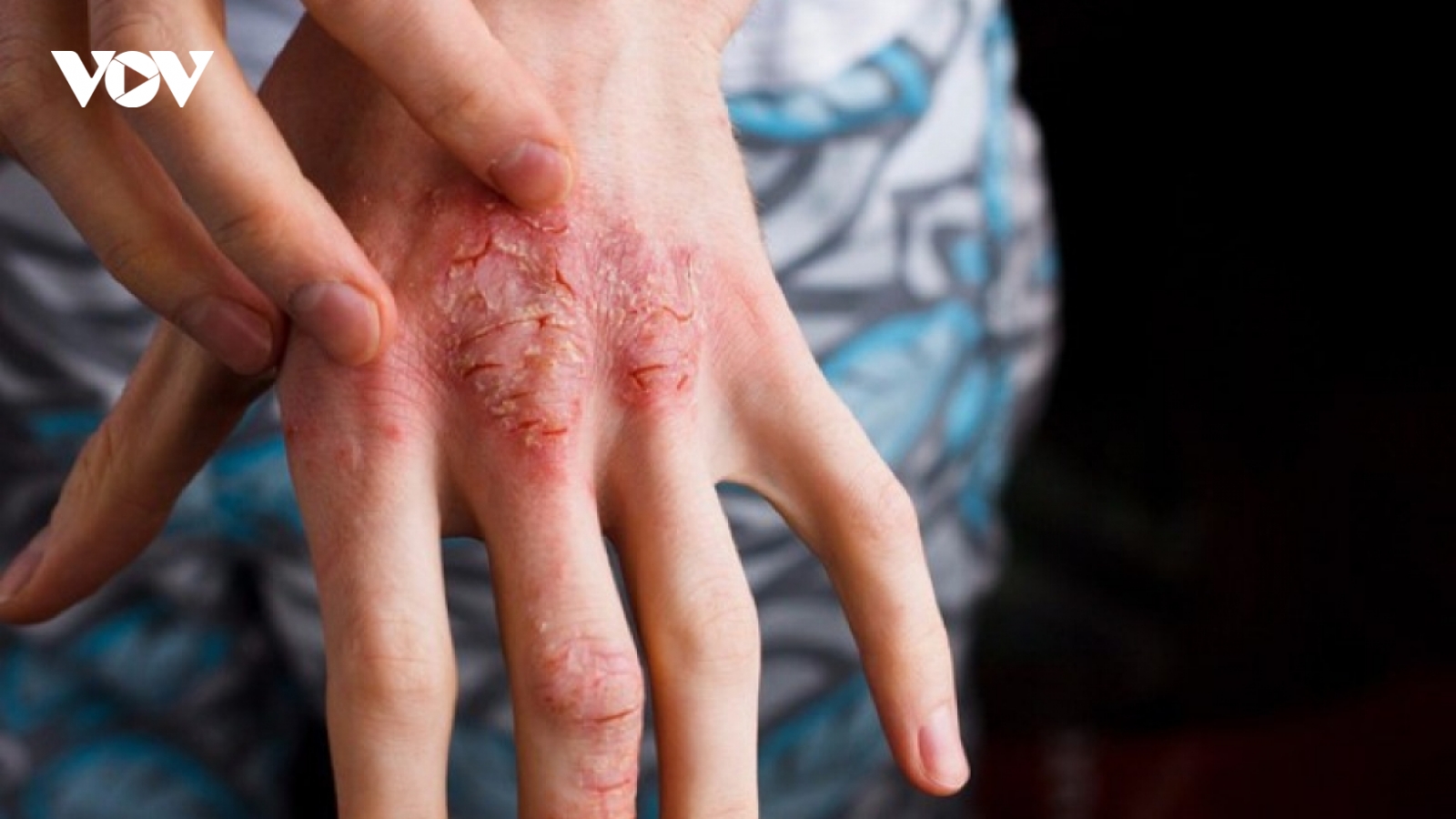 Tẩy giun định kỳ có phòng được bệnh giun sán?