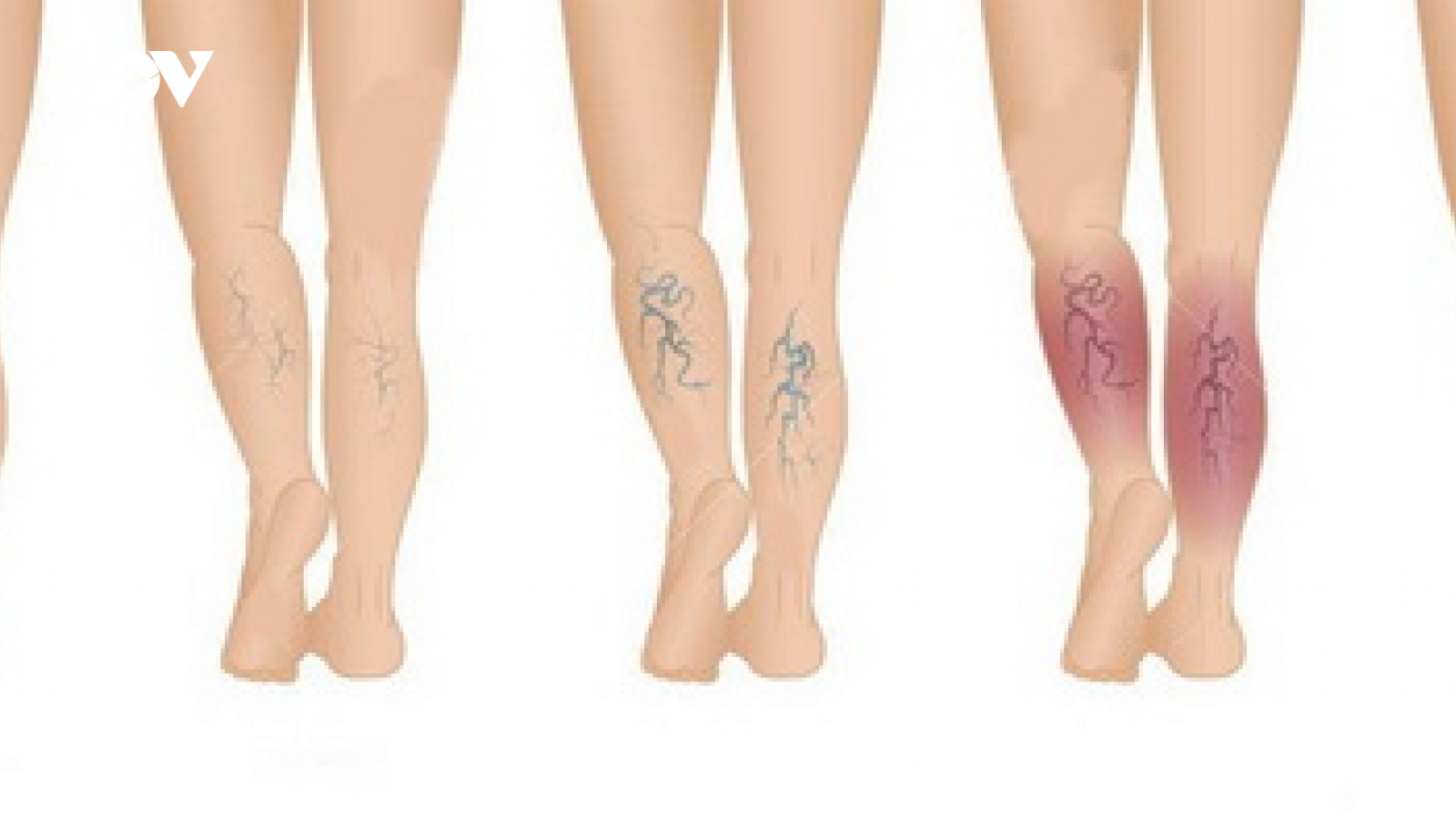 Suy tĩnh mạch mạn tính chi dưới - không thể chủ quan