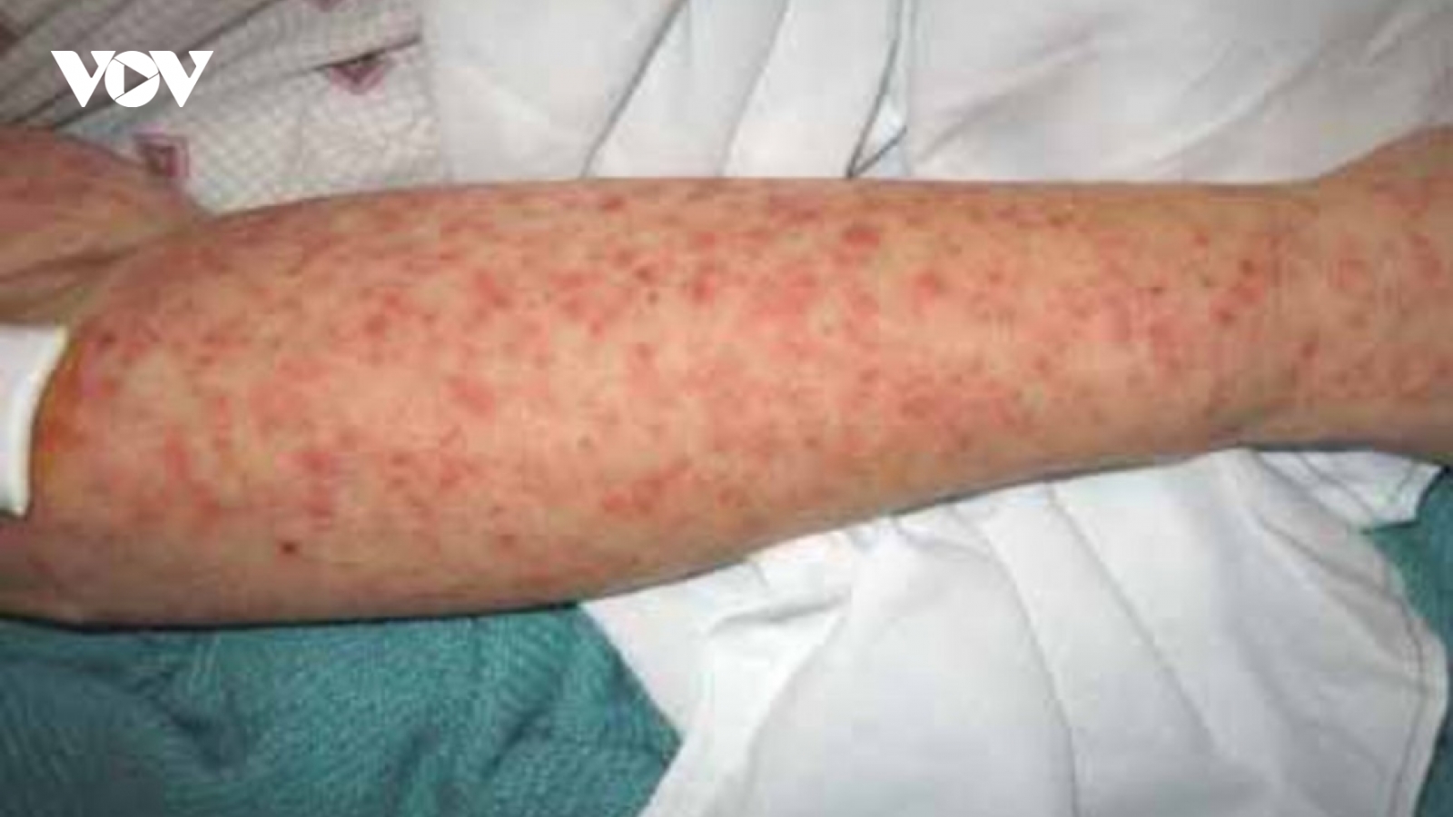 Dịch sốt virus Chikungunya bùng phát tại 13 tỉnh ở Campuchia