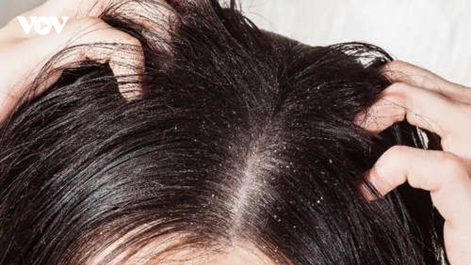 Cách đánh bay gàu ngứa - nỗi ám ảnh mùa hè