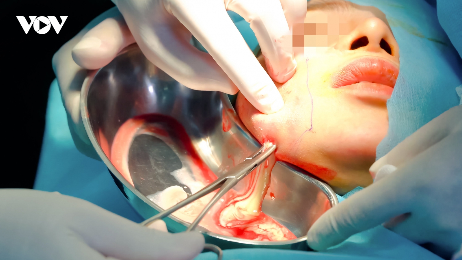 Tiêm filler bị hoại tử nặng, người phụ nữ phải cấp cứu giữa lúc giãn cách xã hội