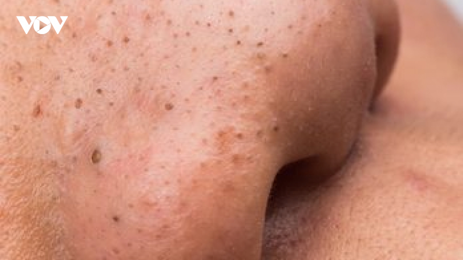 8 công thức tại nhà giúp loại bỏ mụn đầu đen cực kỳ hiệu quả