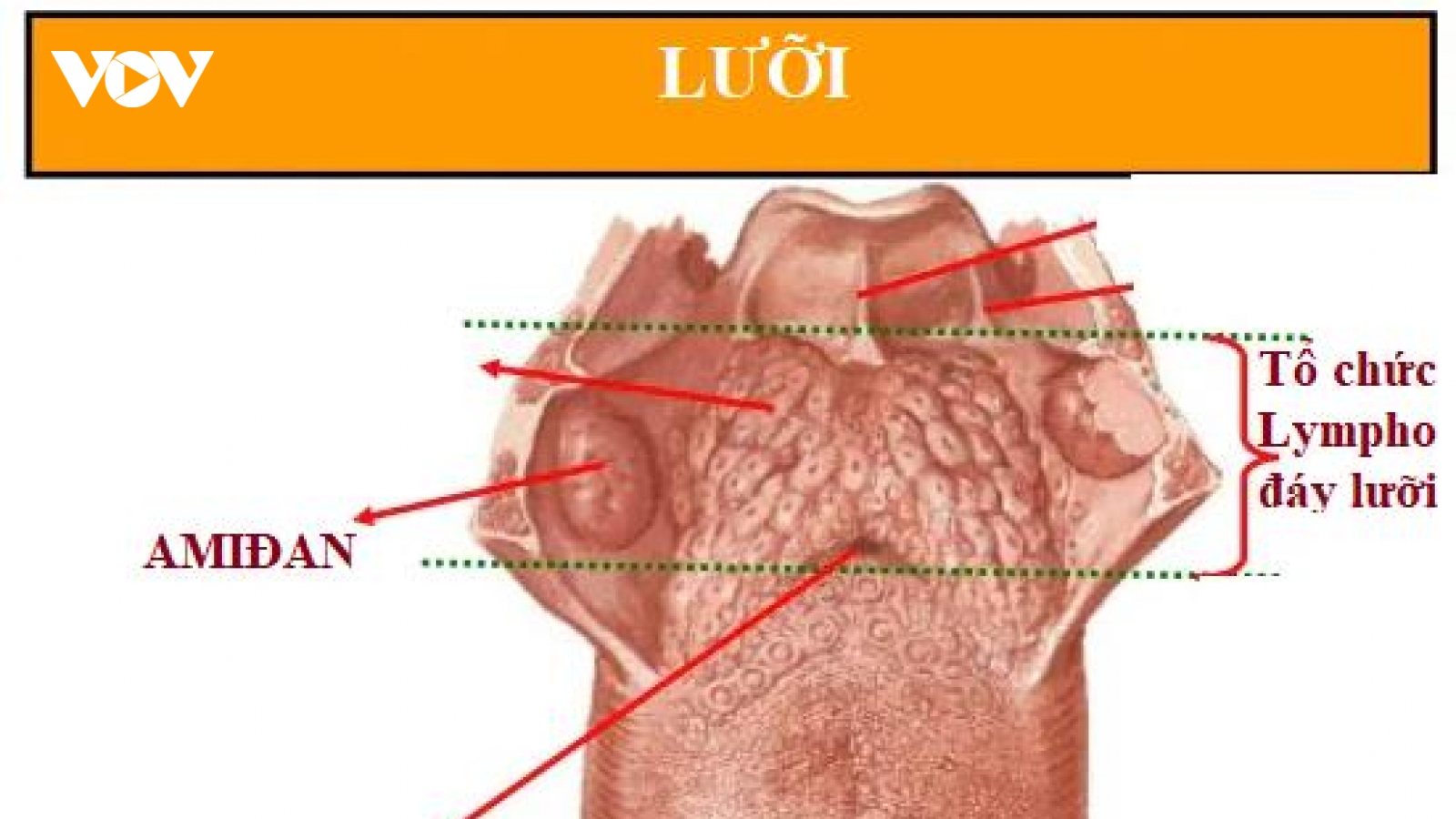 Nốt đỏ ở sau lưỡi và đáy lưỡi, có phải bị ung thư không?