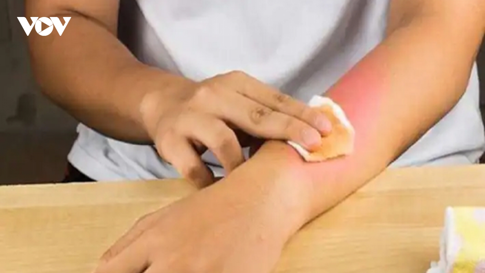 5 biện pháp làm dịu vết bỏng tại nhà