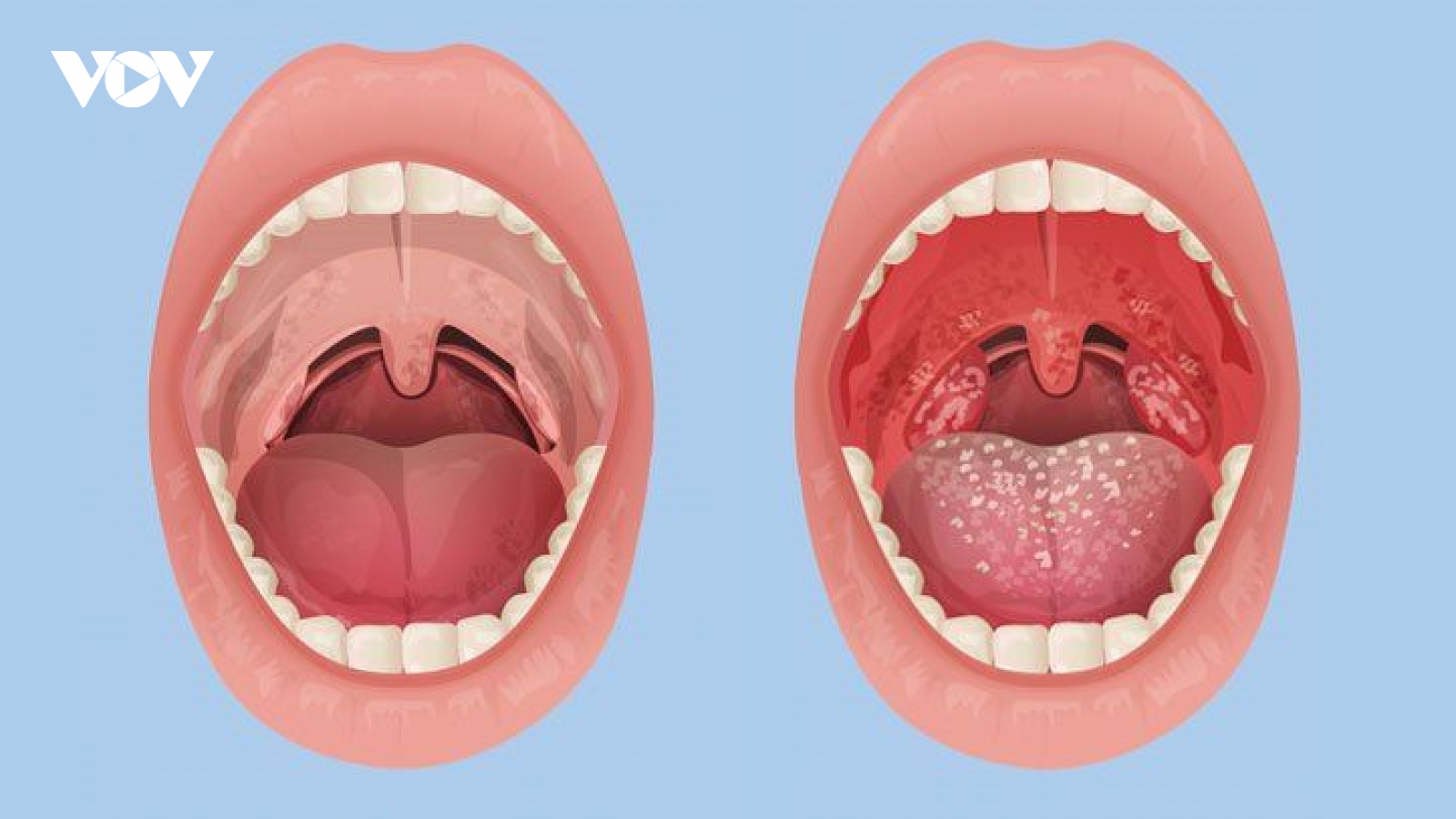 Bị viêm amiđan cấp, khi nào cần đến bệnh viện?