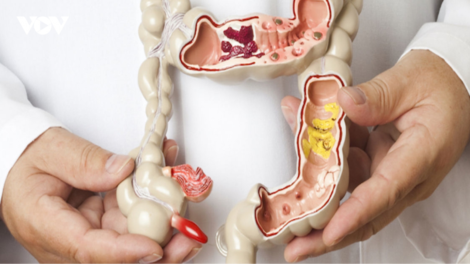 Biến chứng mới sau hồi phục COVID-19 gây khó chịu ở hậu môn
