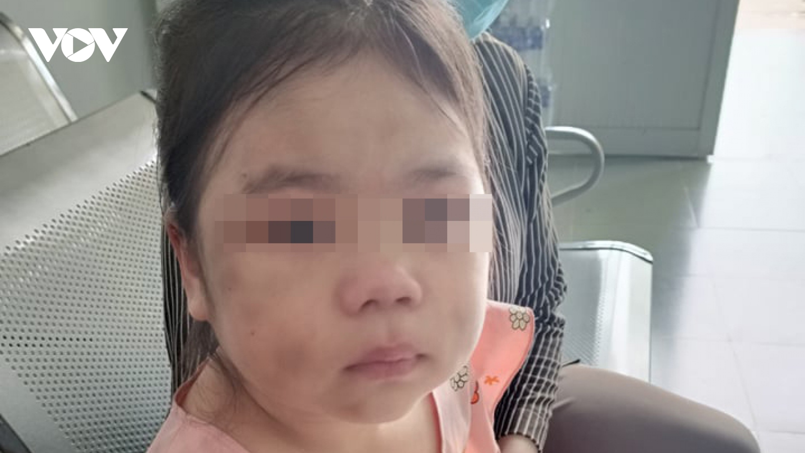 Bé gái 6 tuổi ở Bình Dương bầm tím mặt vì cha “lỡ tay khi dạy học"