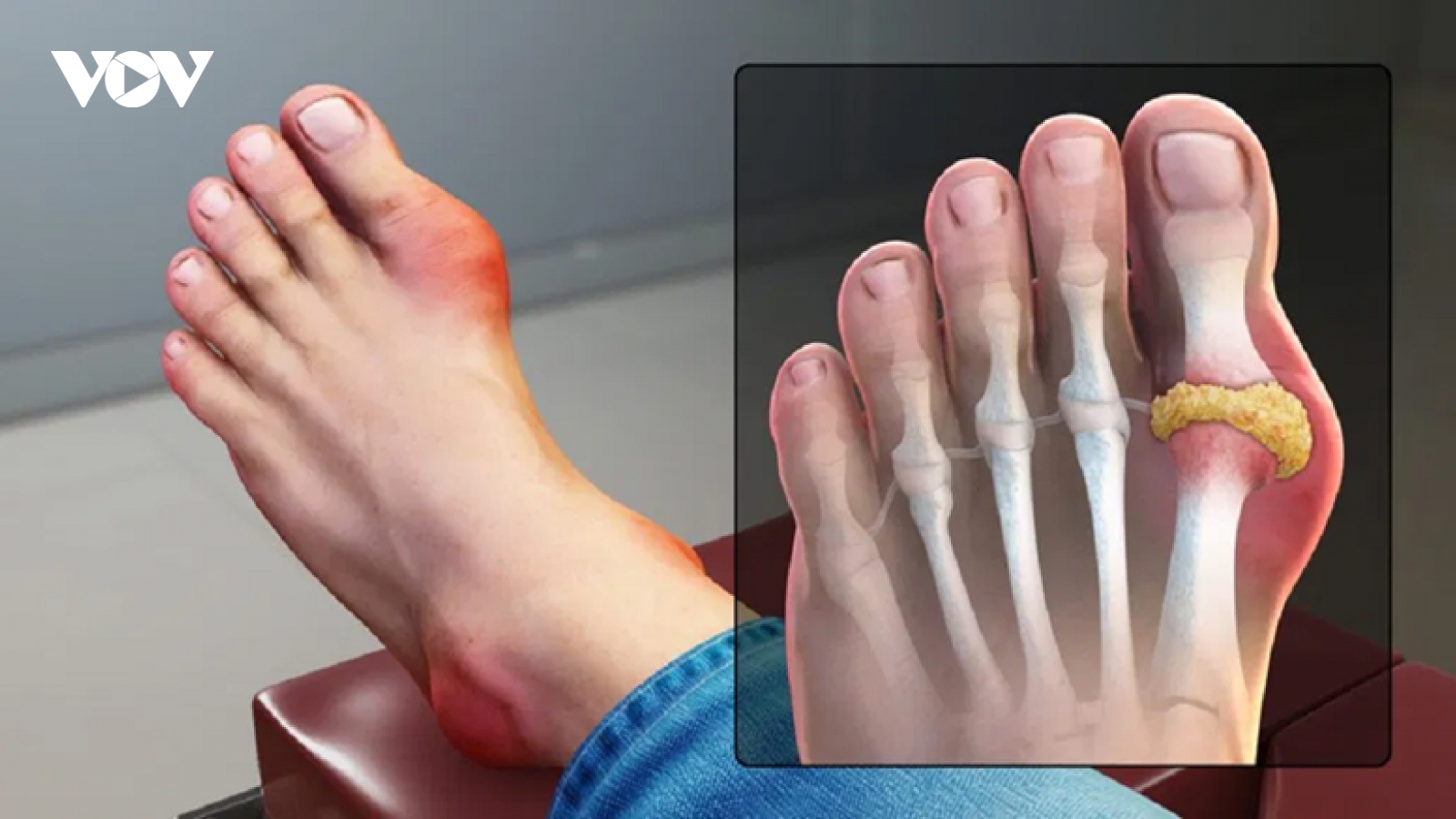 Phân biệt bệnh Gout và bệnh viêm khớp dạng thấp