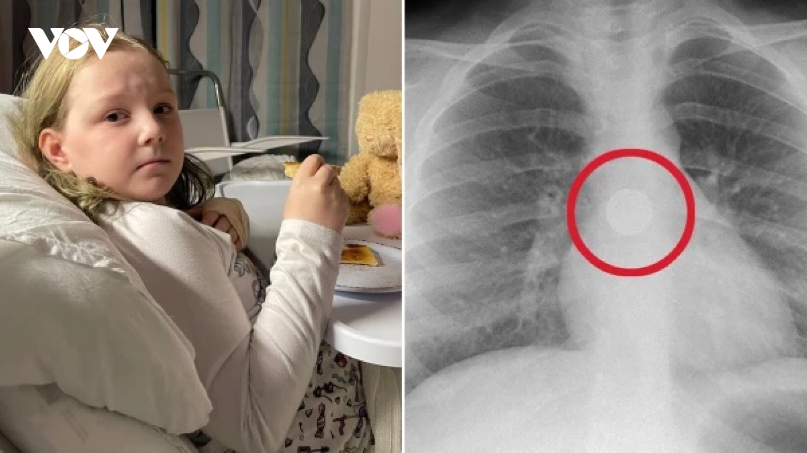 Hành trình cấp cứu bé gái nuốt phải cục pin gây cháy thực quản