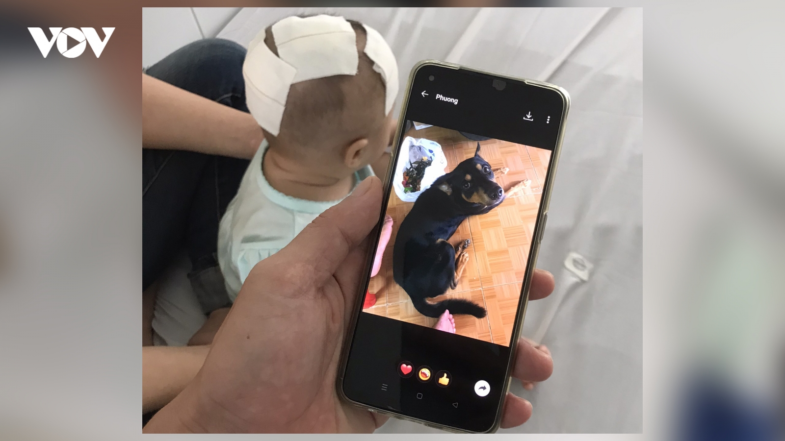 Nghịch thú cưng, bé gái 6 tháng tuổi bị chó cắn xuyên xương sọ