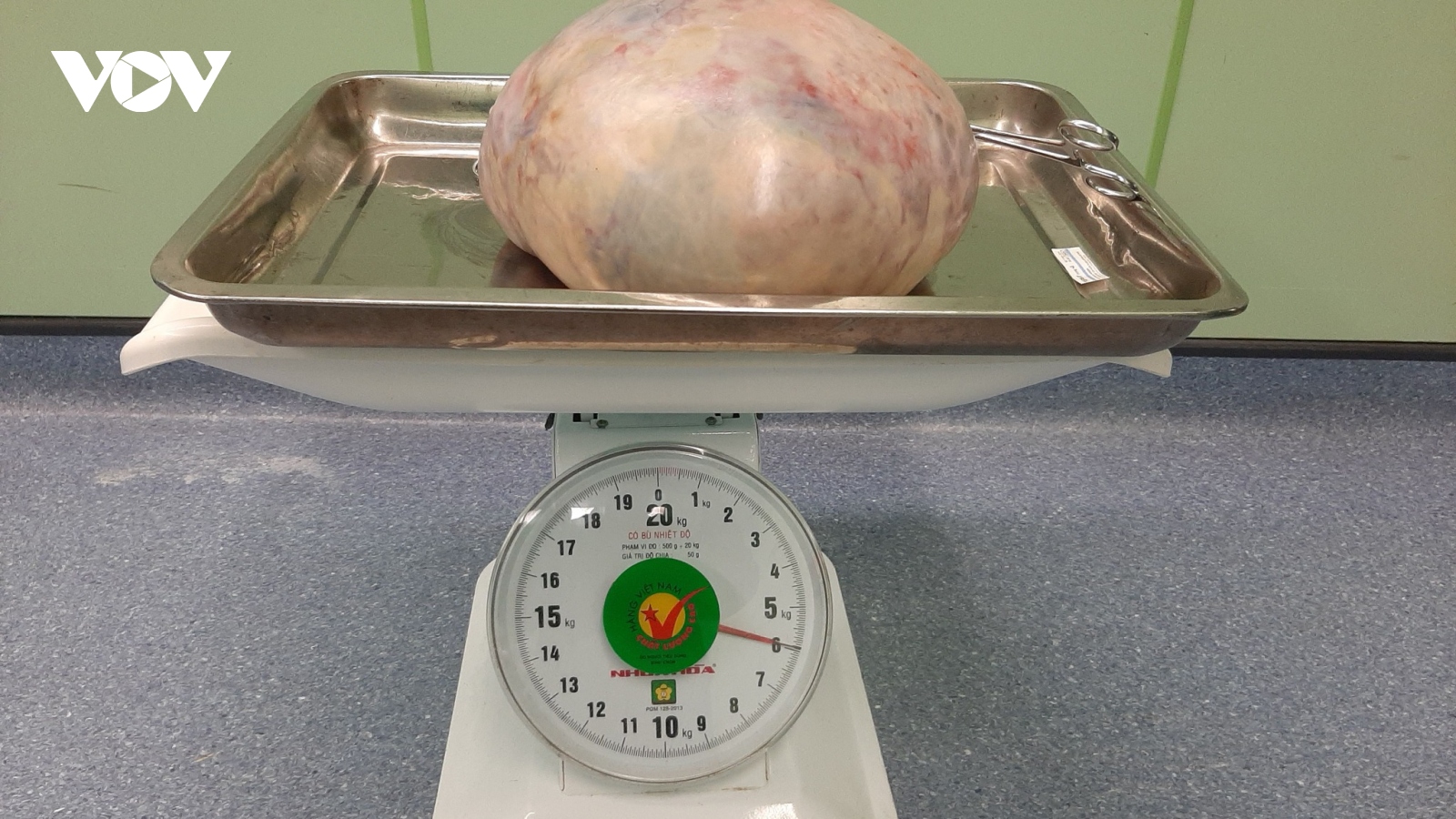 Phẫu thuật lấy khối u khổng lồ nặng gần 6kg ra khỏi cơ thể người phụ nữ
