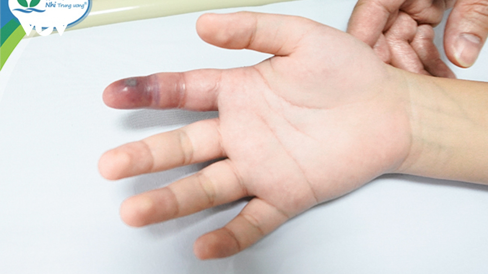 Lén nuôi rắn làm thú cưng, bé trai 13 tuổi bị cắn nguy hiểm tới tính mạng