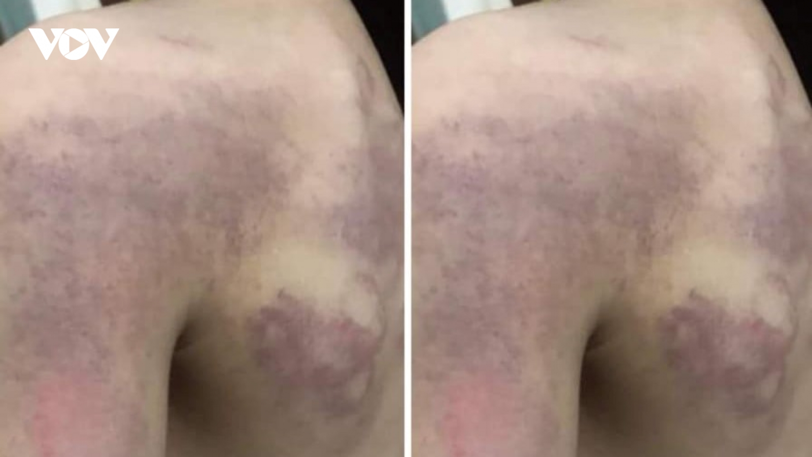 Phụ huynh tá hỏa phát hiện con bầm tím khắp người nghi bị cô giáo đánh
