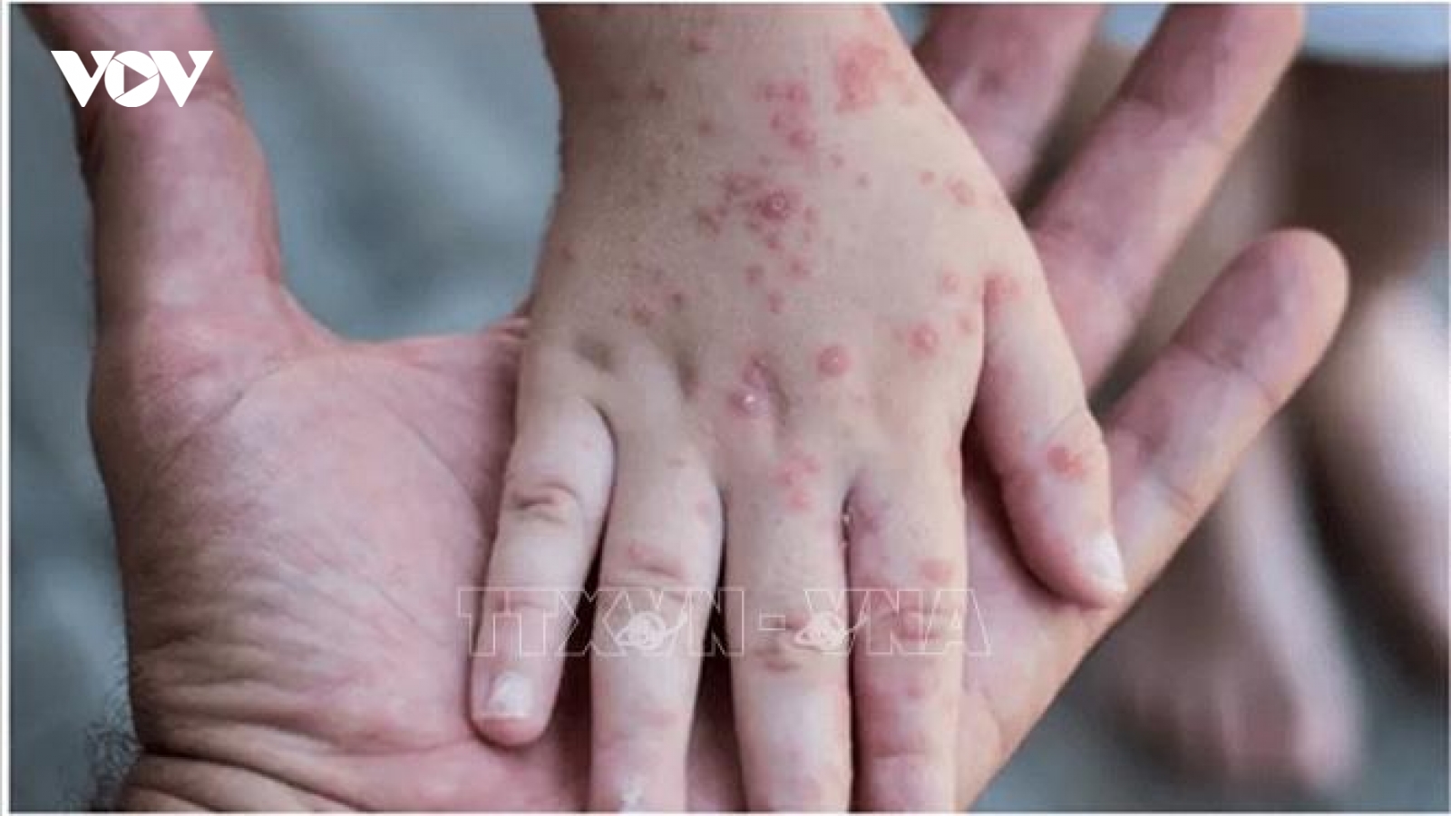 WHO sẽ cân nhắc ban bố tình trạng y tế khẩn cấp đối với bệnh đậu mùa khỉ