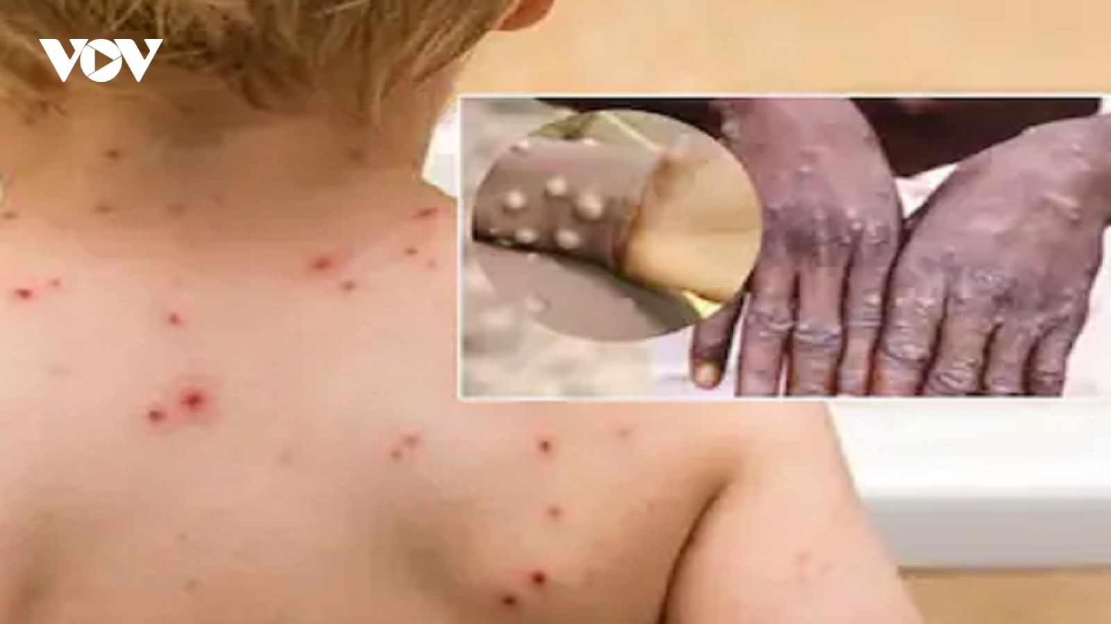 Phân biệt bệnh đậu mùa khỉ và bệnh thủy đậu
