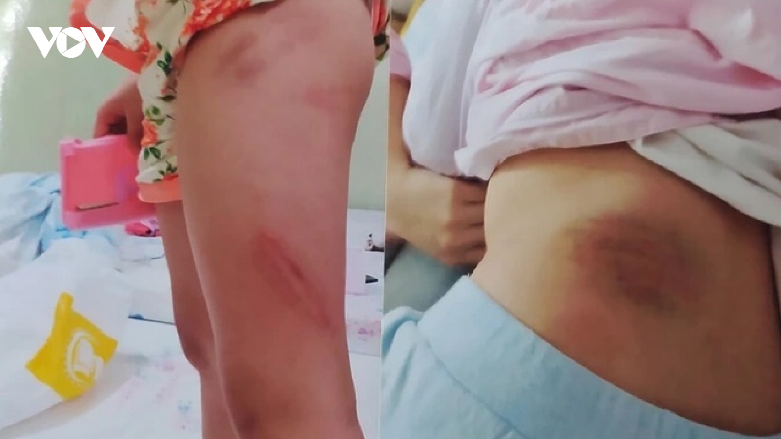 Vụ 2 cháu bé nghi bị bạo hành đến nhập viện: Công an thụ lý đơn khiếu nại