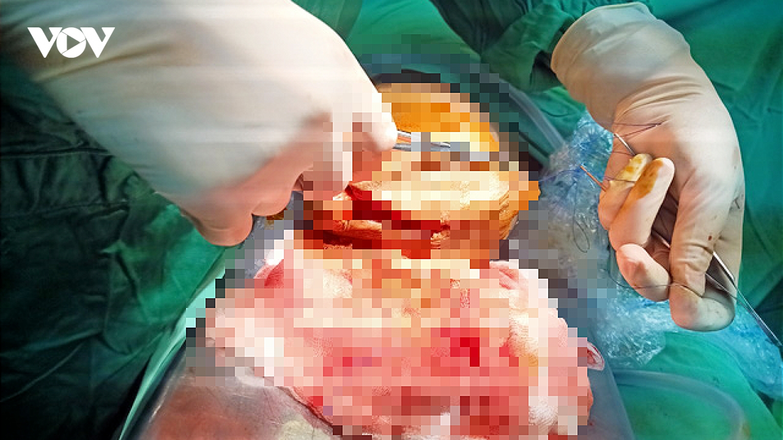Nối thành công dương vật đã bị cắt lìa hơn 6 tiếng