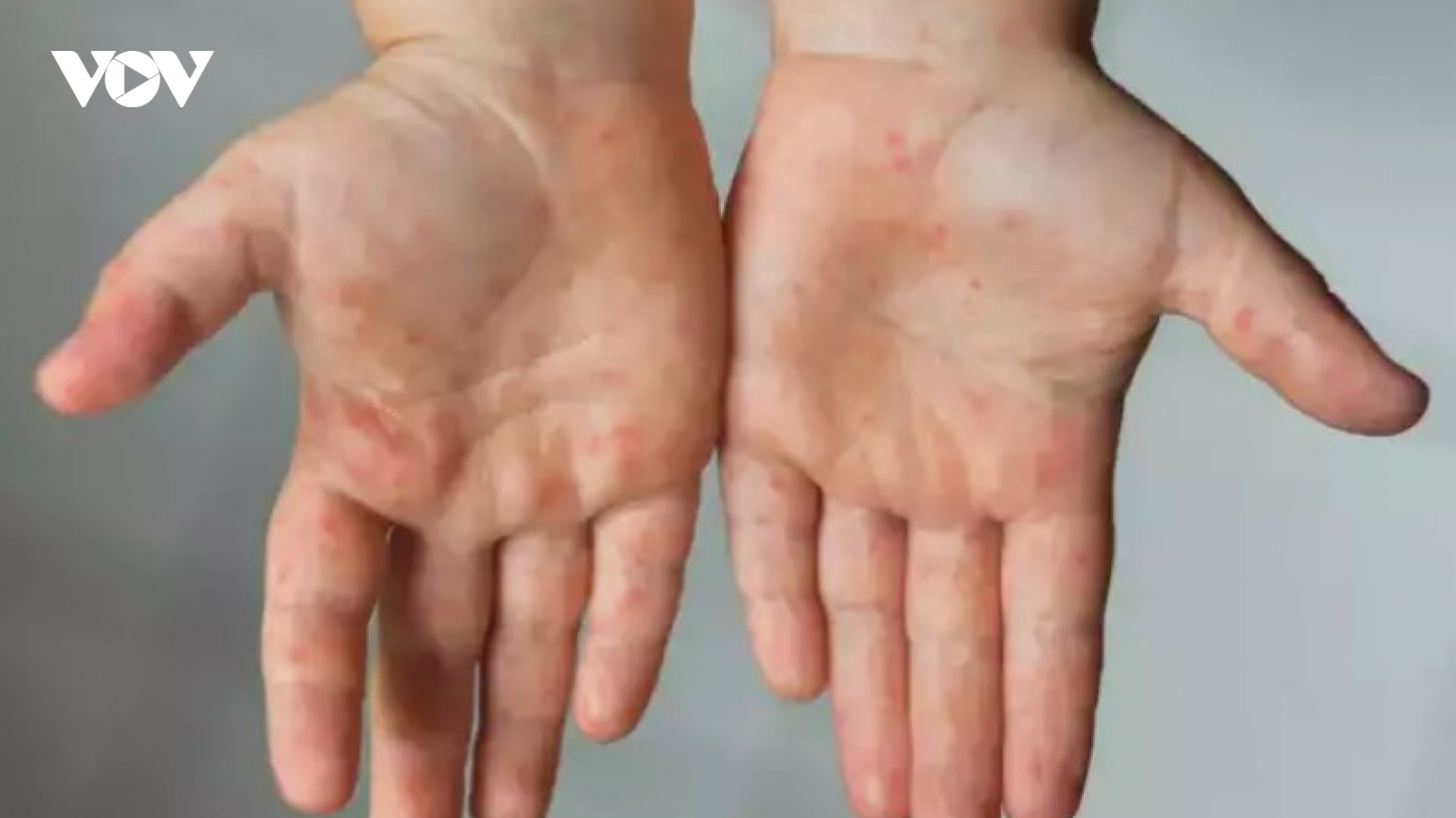 Phân biệt bệnh đậu mùa khỉ và cúm cà chua như thế nào?