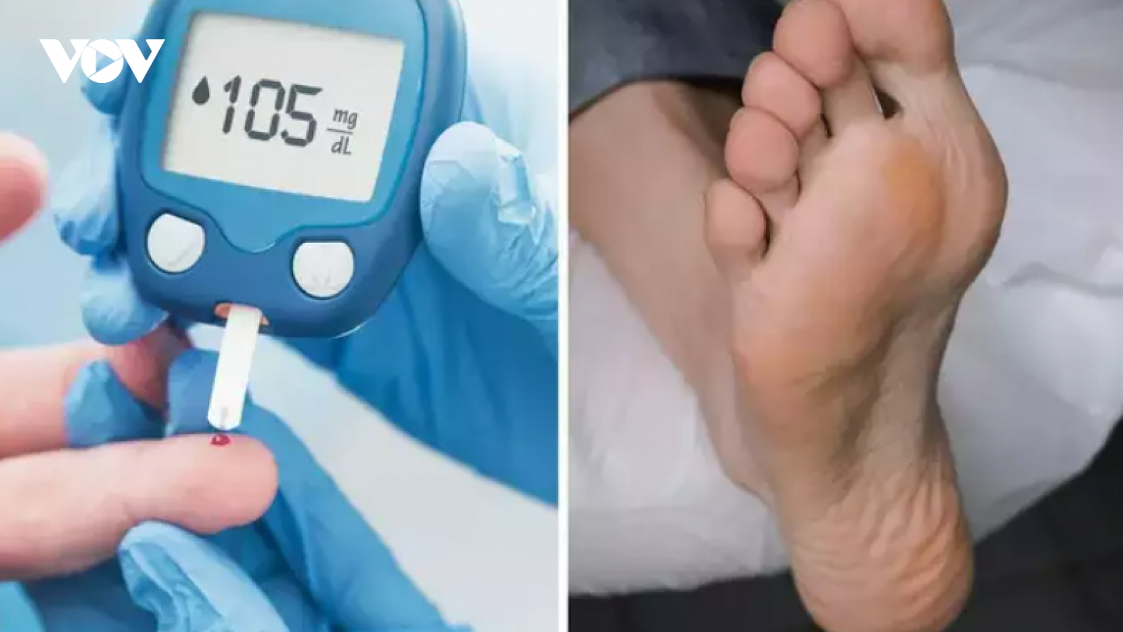 7 dấu hiệu ở chân cho thấy lượng đường trong máu cao