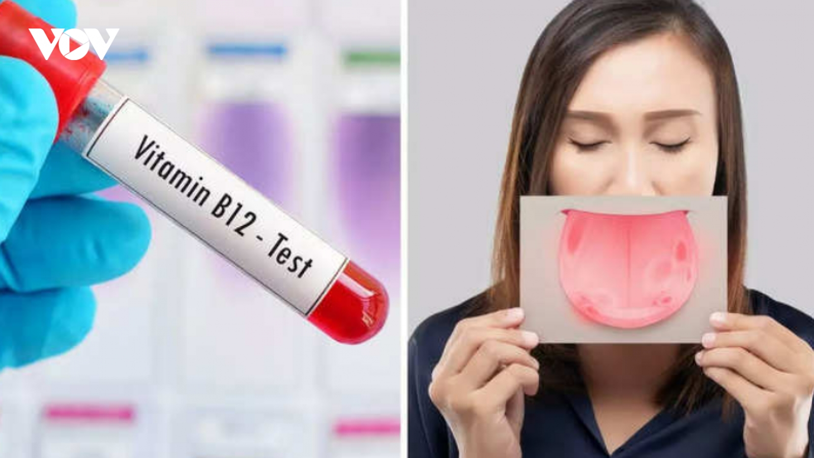 Dấu hiệu này trên lưỡi chứng tỏ bạn thiếu vitamin B12