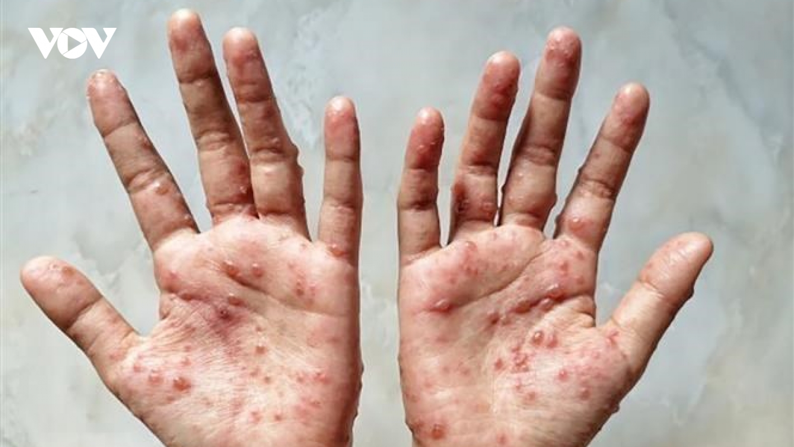 Mỹ tuyên bố dịch bệnh đậu mùa khỉ là tình trạng sức khỏe cộng đồng khẩn cấp