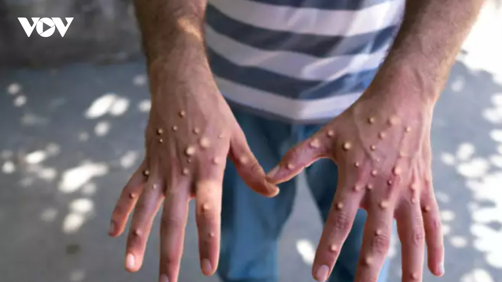 5 điều bạn cần biết để đề phòng bệnh đậu mùa khỉ