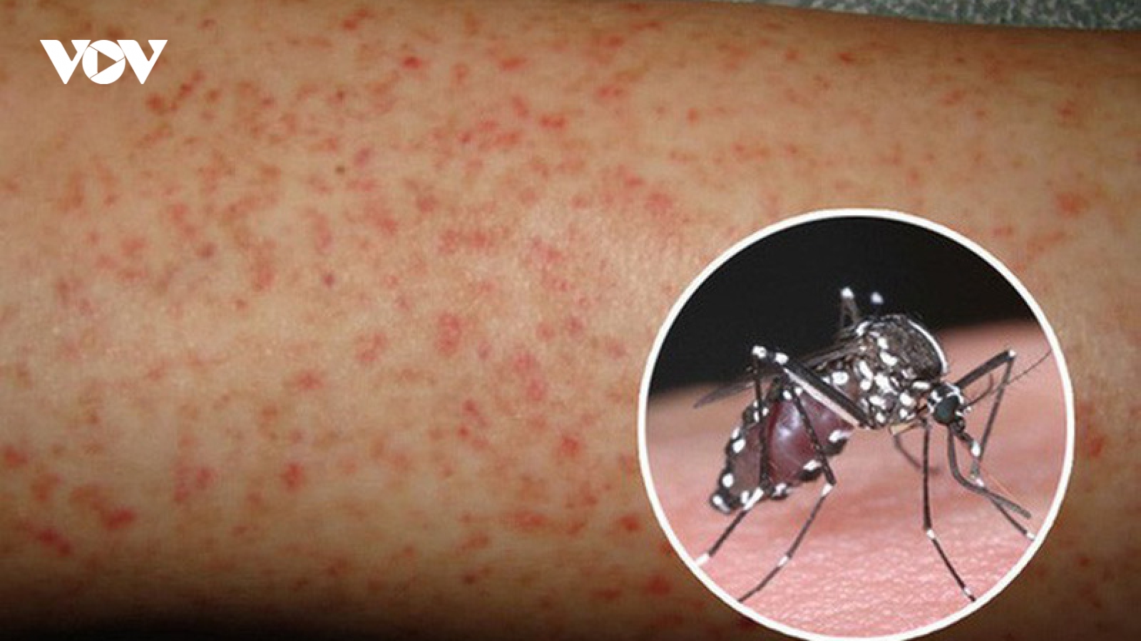Lào cảnh báo người dân về sự nguy hiểm của dịch sốt xuất huyết