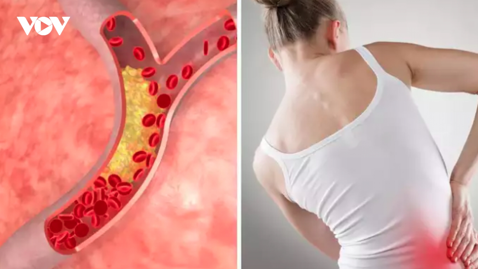 Đau ở 3 vùng này có thể là dấu hiệu của cholesterol cao