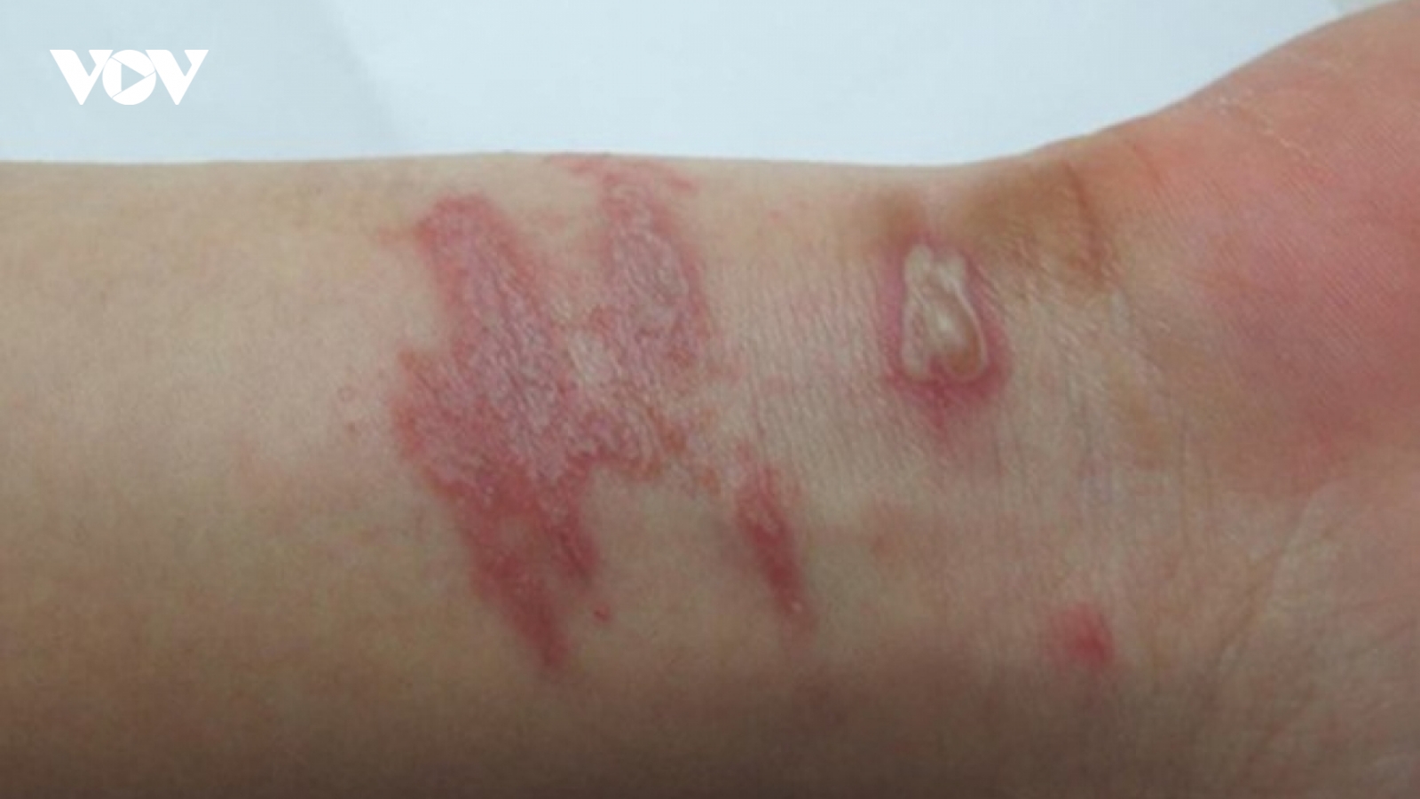 Nhiều người bị viêm da do tiếp xúc với kiến ba khoang