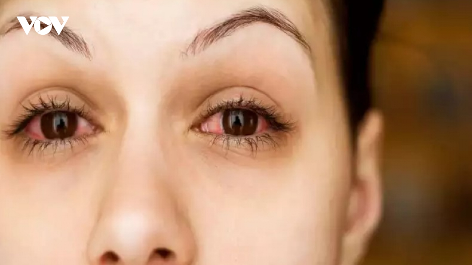 Nguyên nhân phổ biến khiến đôi mắt bạn đỏ ngầu