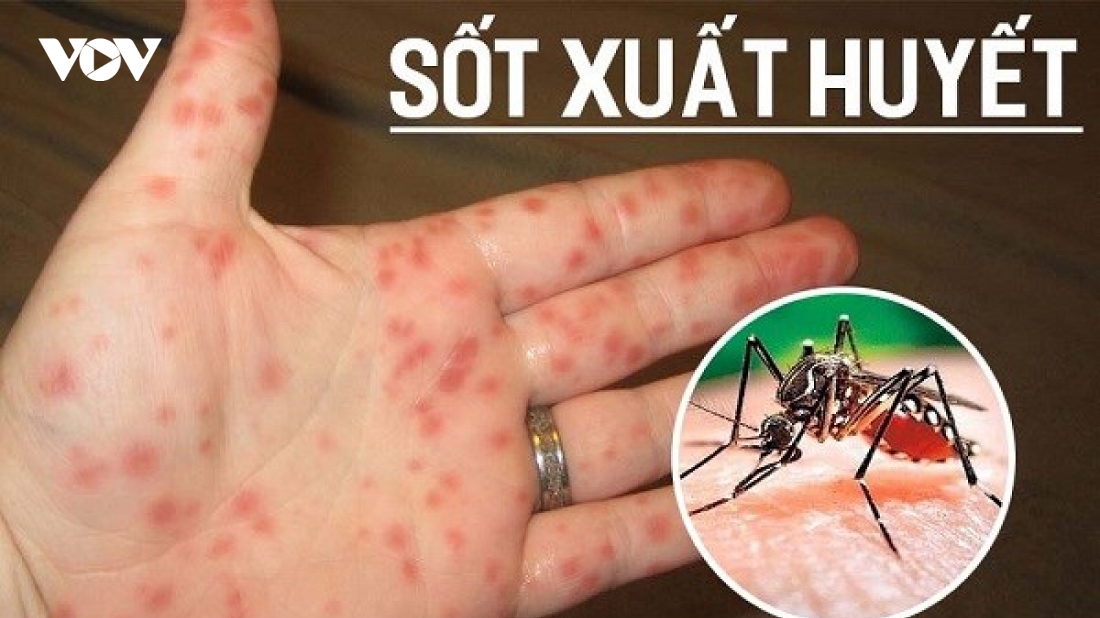 Dịch sốt xuất huyết vẫn chưa "giảm nhiệt", giải pháp nào để giảm ca nặng và tử vong?
