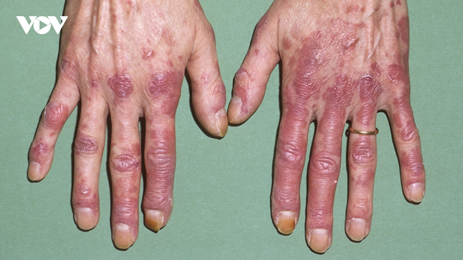 Dùng đơn thuốc cũ, bệnh nhân lupus ban đỏ phải nhập viện cấp cứu