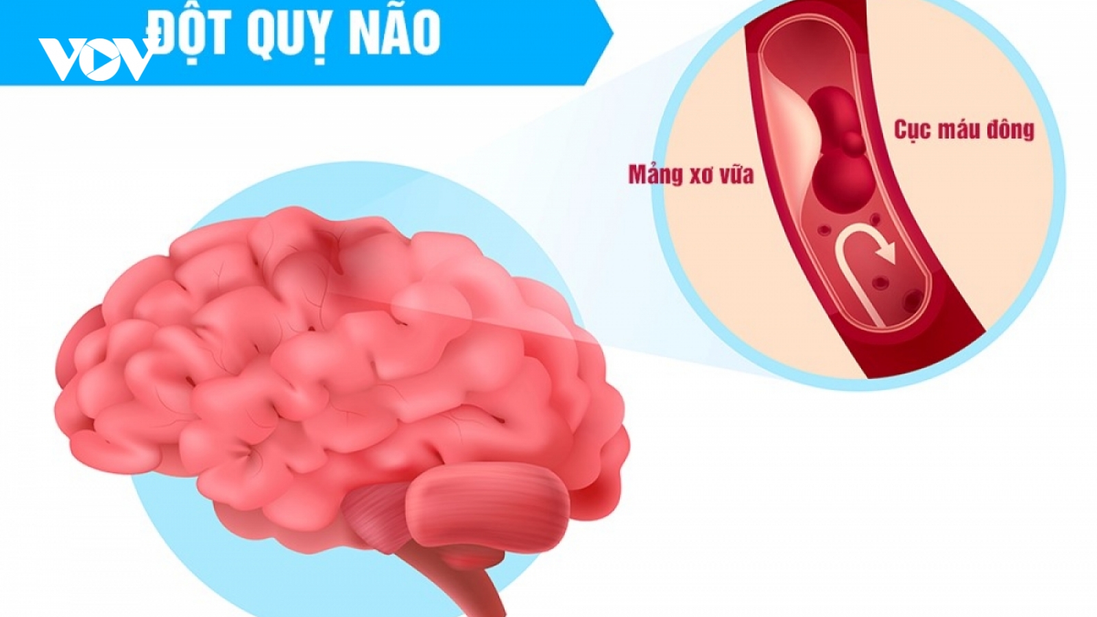 Quy tắc F.A.S.T giúp nhận diện sớm cơn đột quỵ