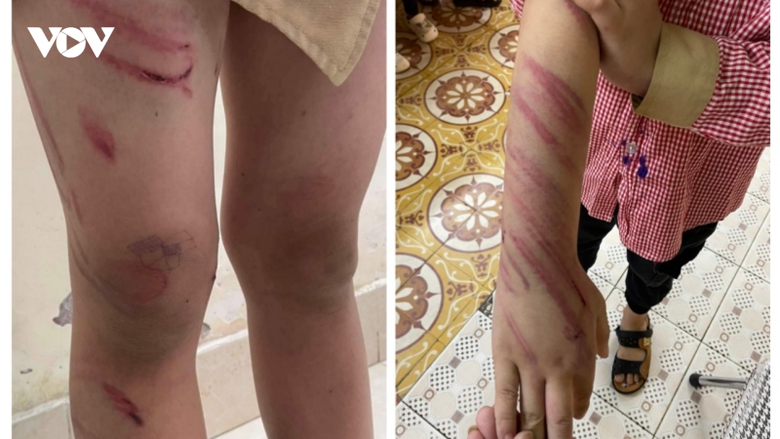Cháu bé đầy vết thương trên người, nghi bị bạn trai của mẹ bạo hành