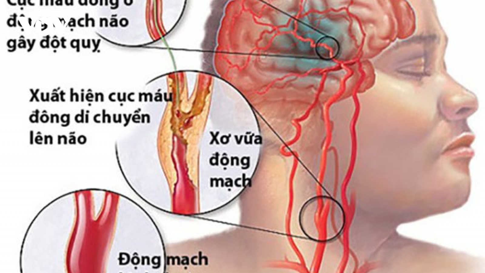 Chảy máu não - biến chứng nguy hiểm của sốt xuất huyết