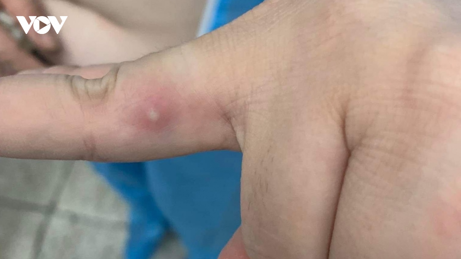 Ca bệnh đậu mùa khỉ thứ 2 ở Việt Nam đã được xuất viện